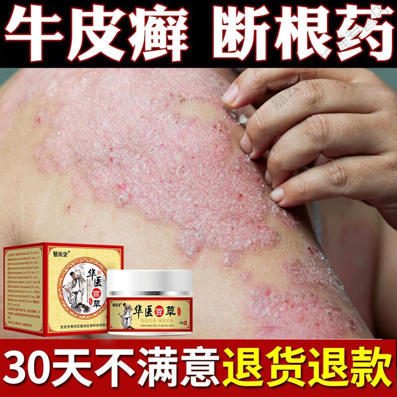 后背长痘痘起小水泡脱皮肤瘙痒过敏止痒癣膏箹