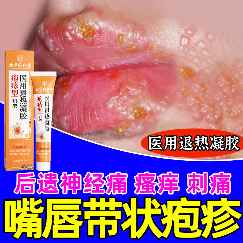 嘴唇带状泡疹疱疹可搭日本特的效药断艮克星北京医用退热凝胶疹康型荨