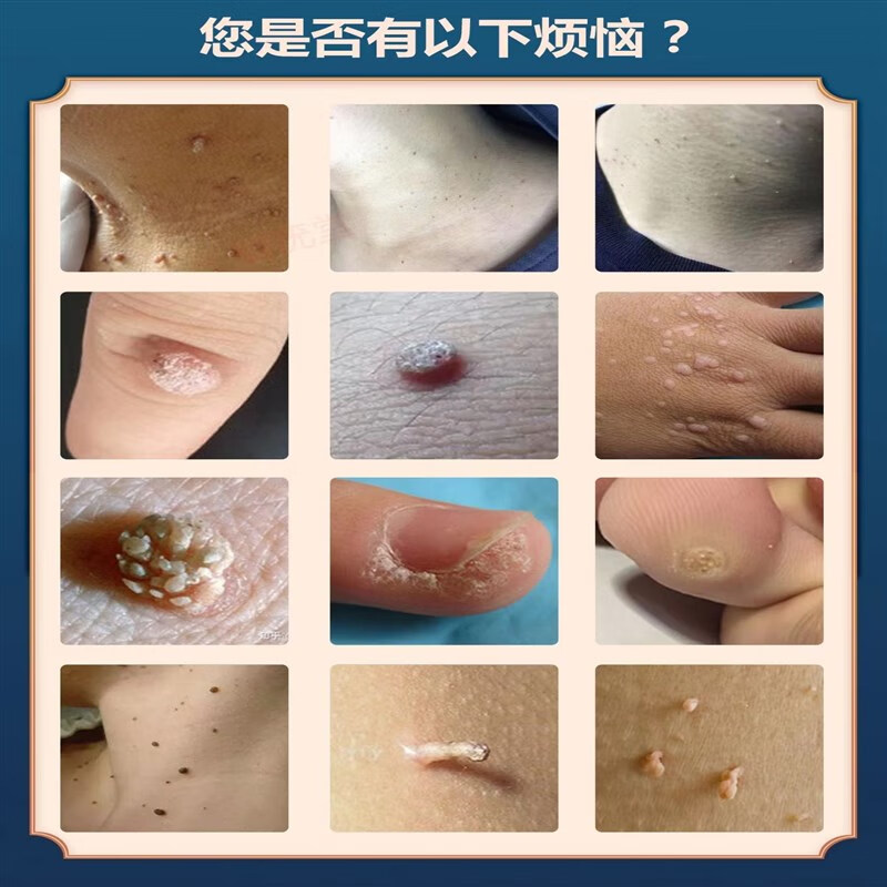 蕲大姐新款抑菌液尖锐克忧活性hpv溶酶湿尤鸡眼丝状忧肉刺瘊子