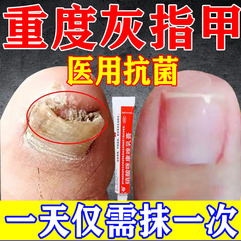 灰指甲根药正ii品治疗甲癣灰指甲药膏指甲真菌感染脱甲坏甲硝酸咪康唑