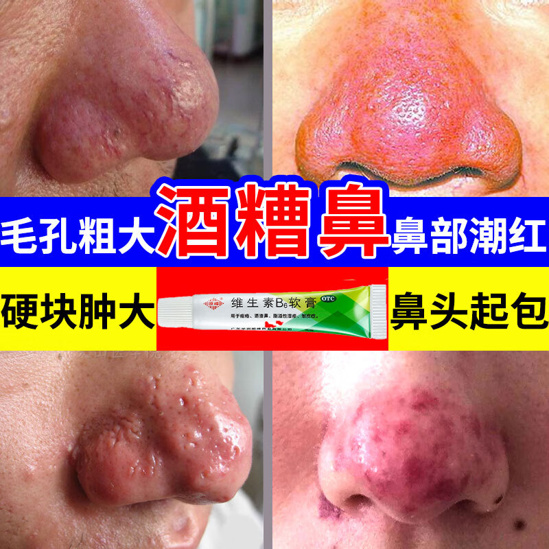 治酒糟鼻药膏 草莓鼻红鼻子酒渣鼻鼻头除螨虫 鼻头硬块黑头粉刺草莓鼻