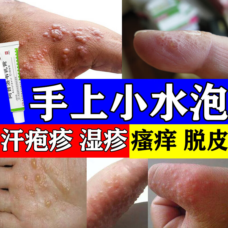 手干脱皮止炎消痒膏湿疹皮炎瘙痒各种湿疹真菌感染抗过敏阿昔洛韦乳膏
