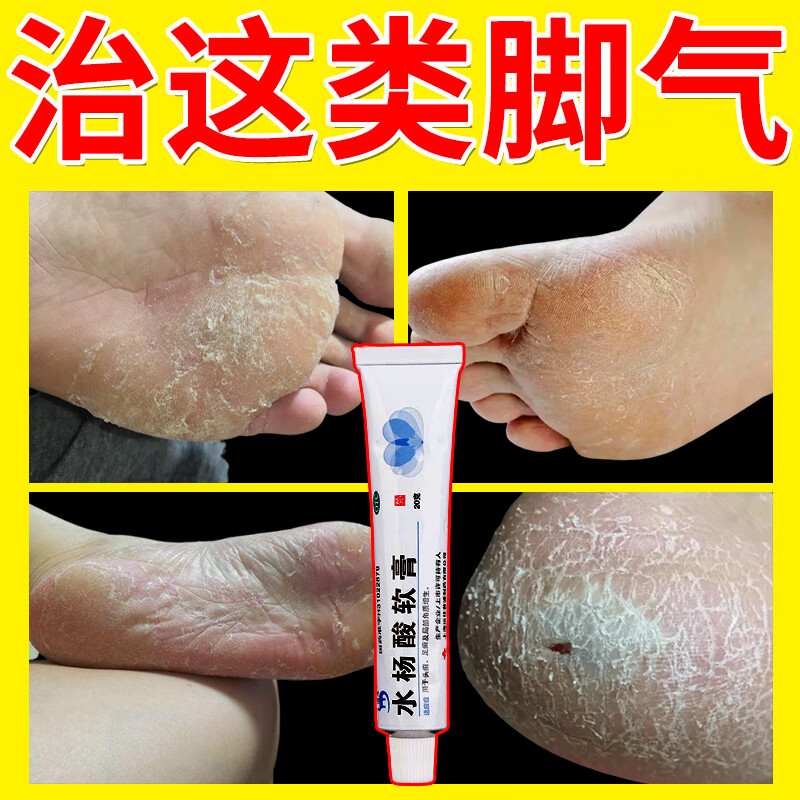 信龙 水杨酸软膏 药止痒脱皮烂脚丫真菌感染止痒 脚脱皮角质增厚烂