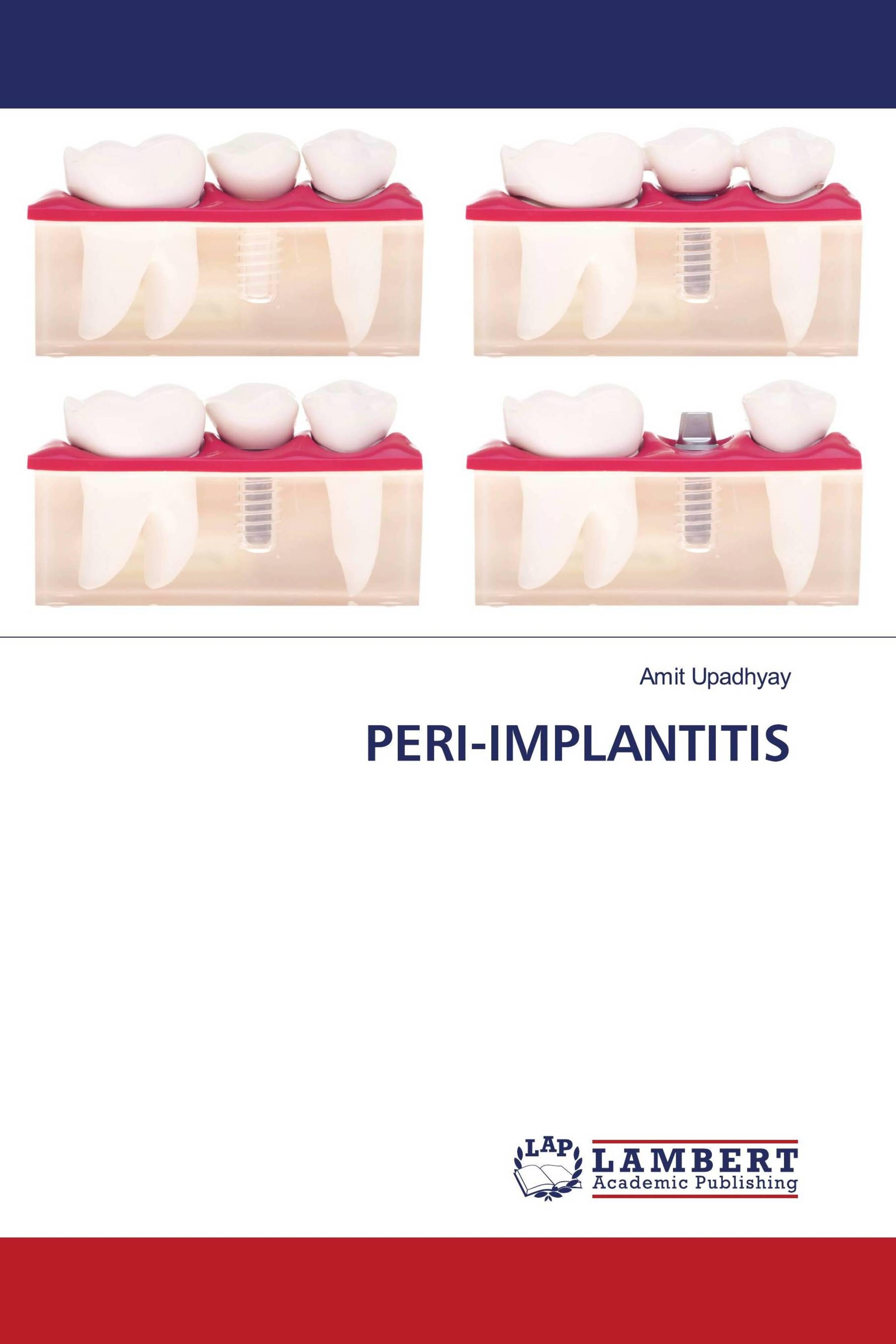 预订Peri-Implantitis