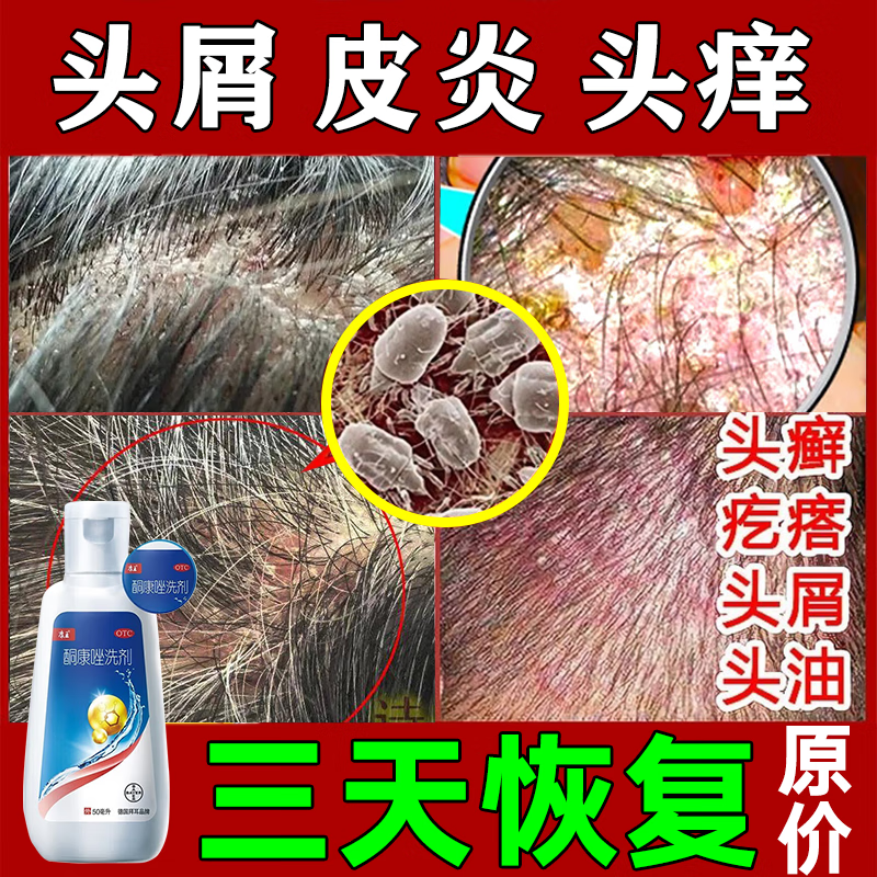 大瓶50ml酮康唑洗剂 硝酸咪康唑乳膏【专家建议】