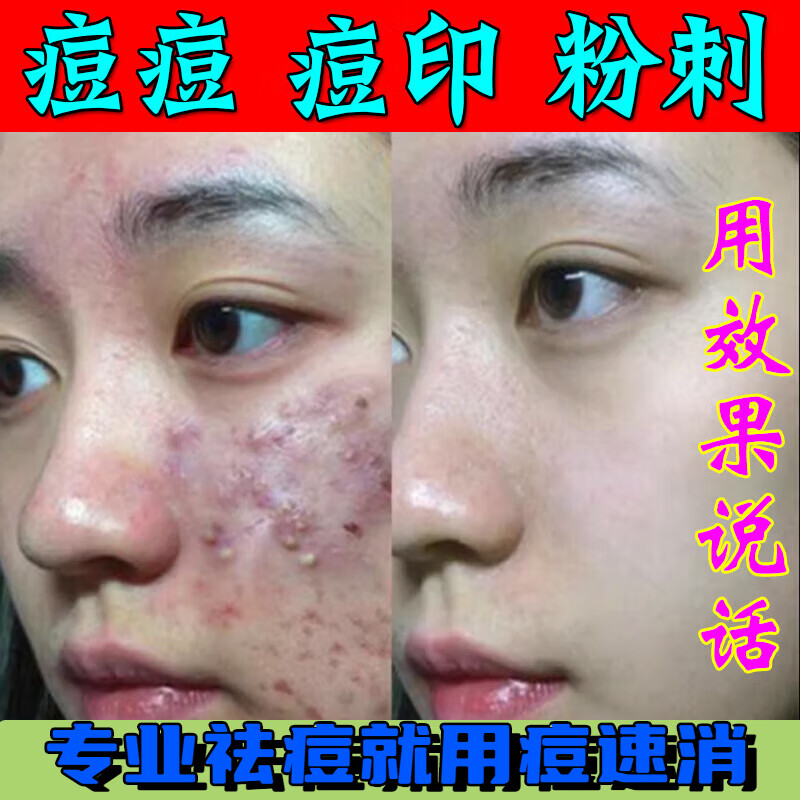 痘速消【祛痘】痘痘修复消炎痘印青春痘祛痘膏男女学生祛痘专用l药 1