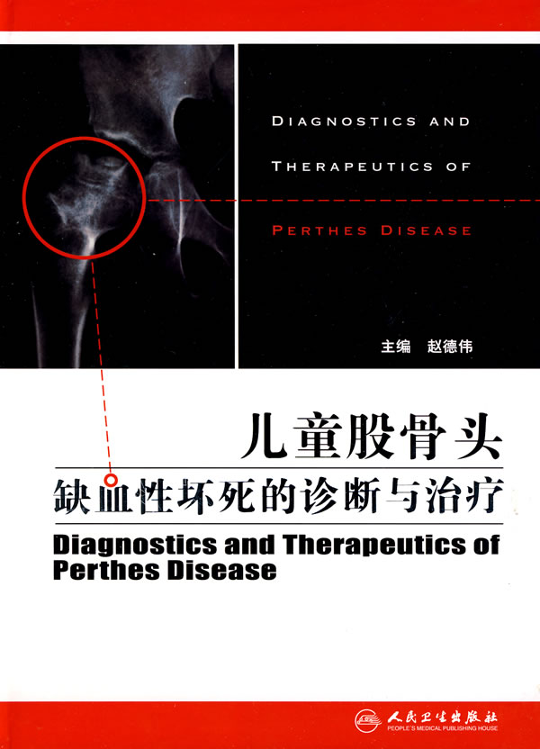 儿童股骨头缺血性坏死的诊断与治疗
