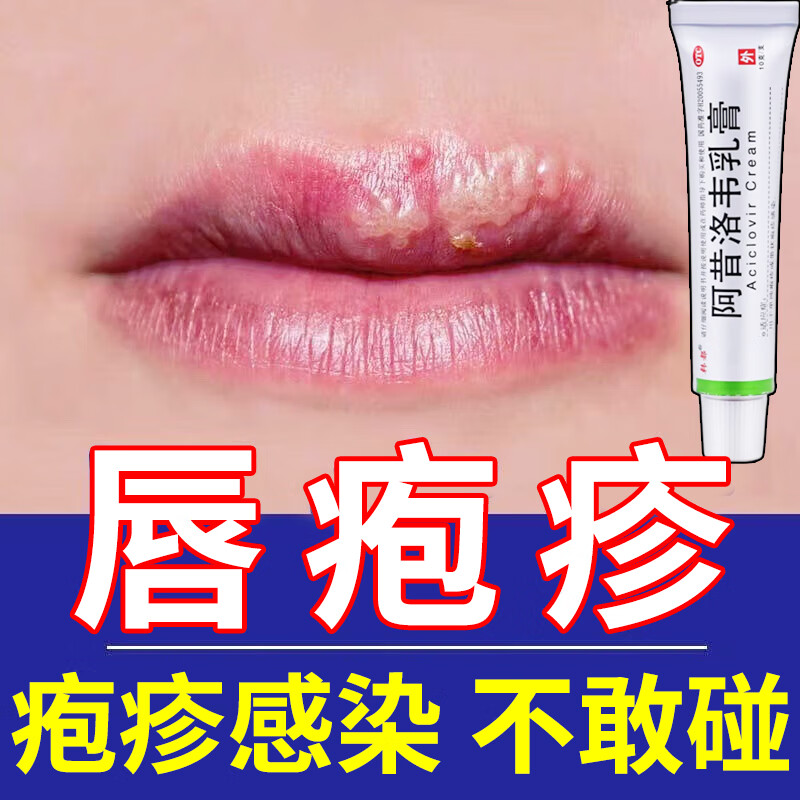 疱疹感染引起的口角炎烂嘴角上火起泡嘴巴脓疮 止痒药膏 嘴角起泡药膏