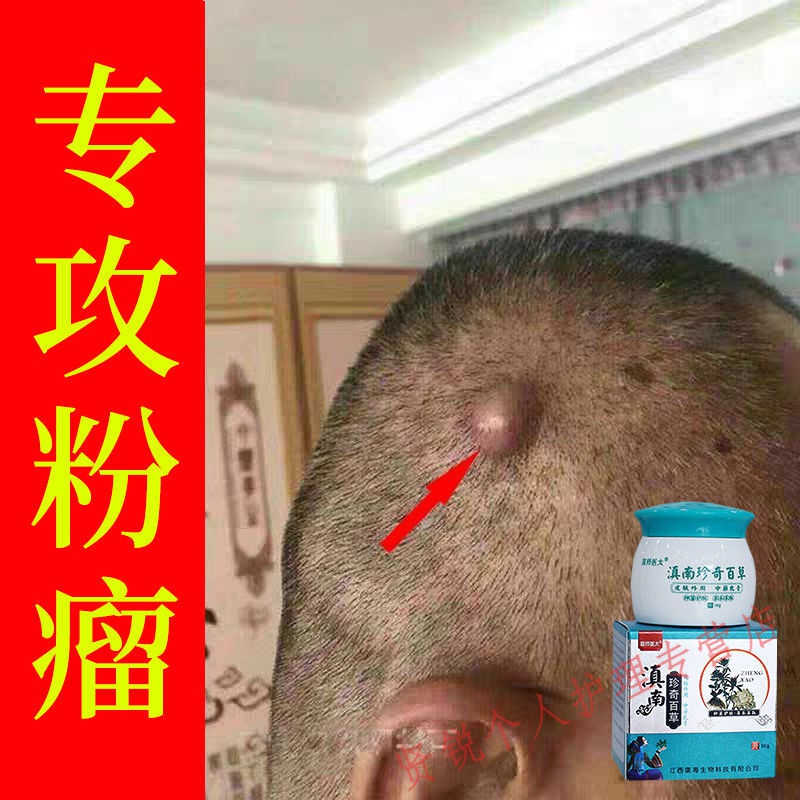【专冶粉瘤克星】去除耳后粉瘤治皮脂腺囊肿疏通皮下脂肪硬块疙瘩