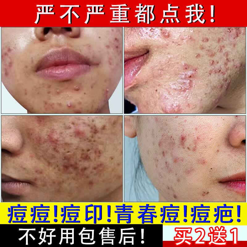 草本京佩祛痘I印修复淡化痘印痘坑修复药I膏青春痘祛痘膏学生去痘痘和痘印高性价比高么？