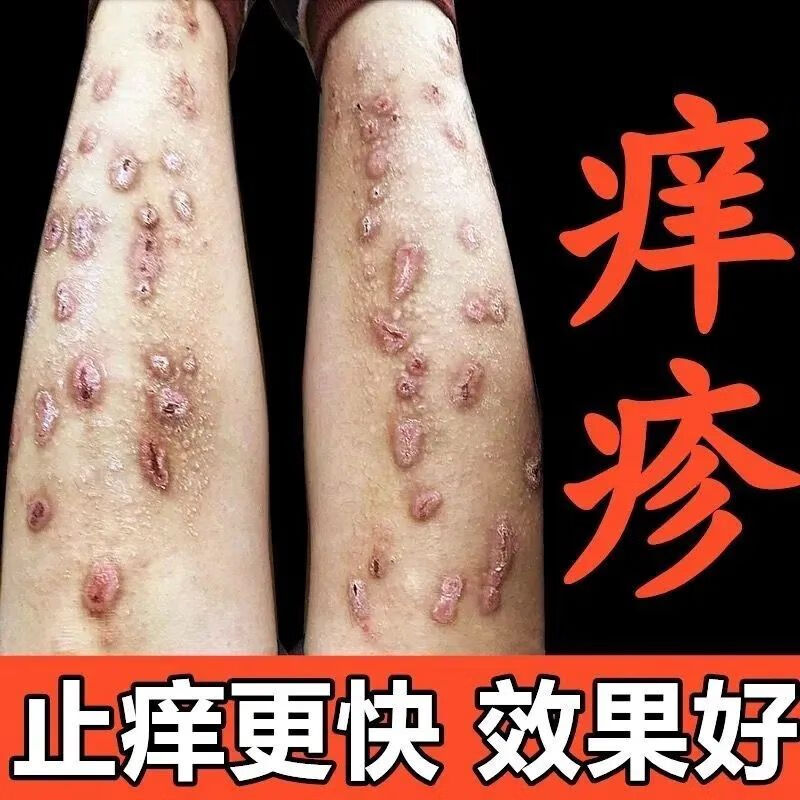 黎维莎官方问结节性痒l疹膏止痒祛疙瘩顽固性慢性痒l疹节结性皮肤l 热