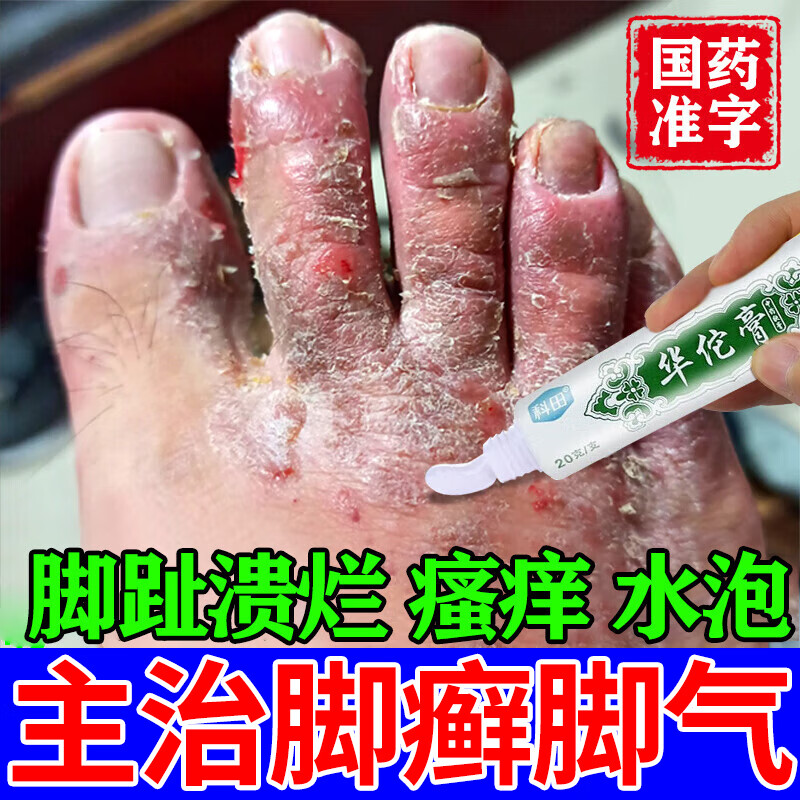 治脚气的特药 脚气药止痒脱皮烂脚丫真菌感染止痒脚气膏脚痒脚臭根要