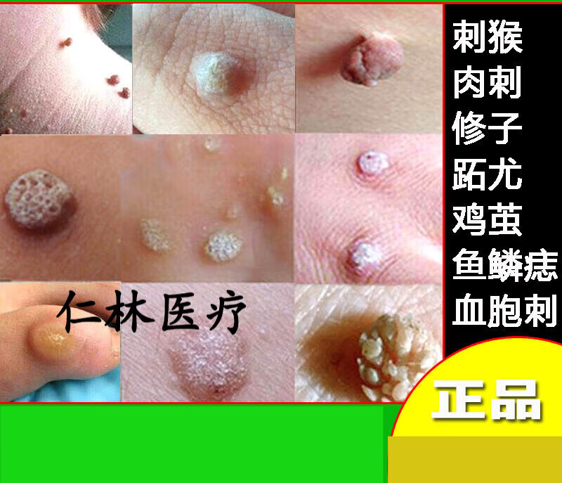 【京健康】猴去除鱼鳞痣手足部肉刺膏点治候药瘊子神跖尤血胞刺灵