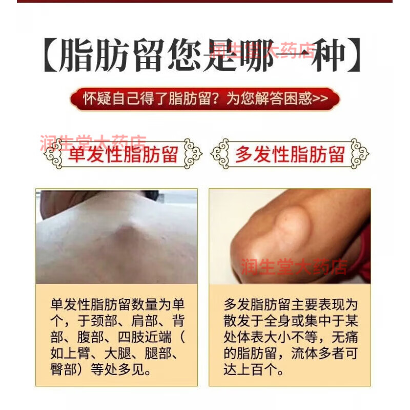 脂肪康去除膏脂肪瘤专用日本进口技术去除神器消除皮下囊肿硬块皮脂腺