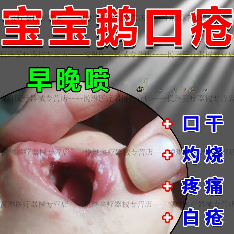 婴儿鹅口疮凝胶口腔喷剂婴儿口腔喷剂宝宝雪口疮白口糊口疮神器喷 单