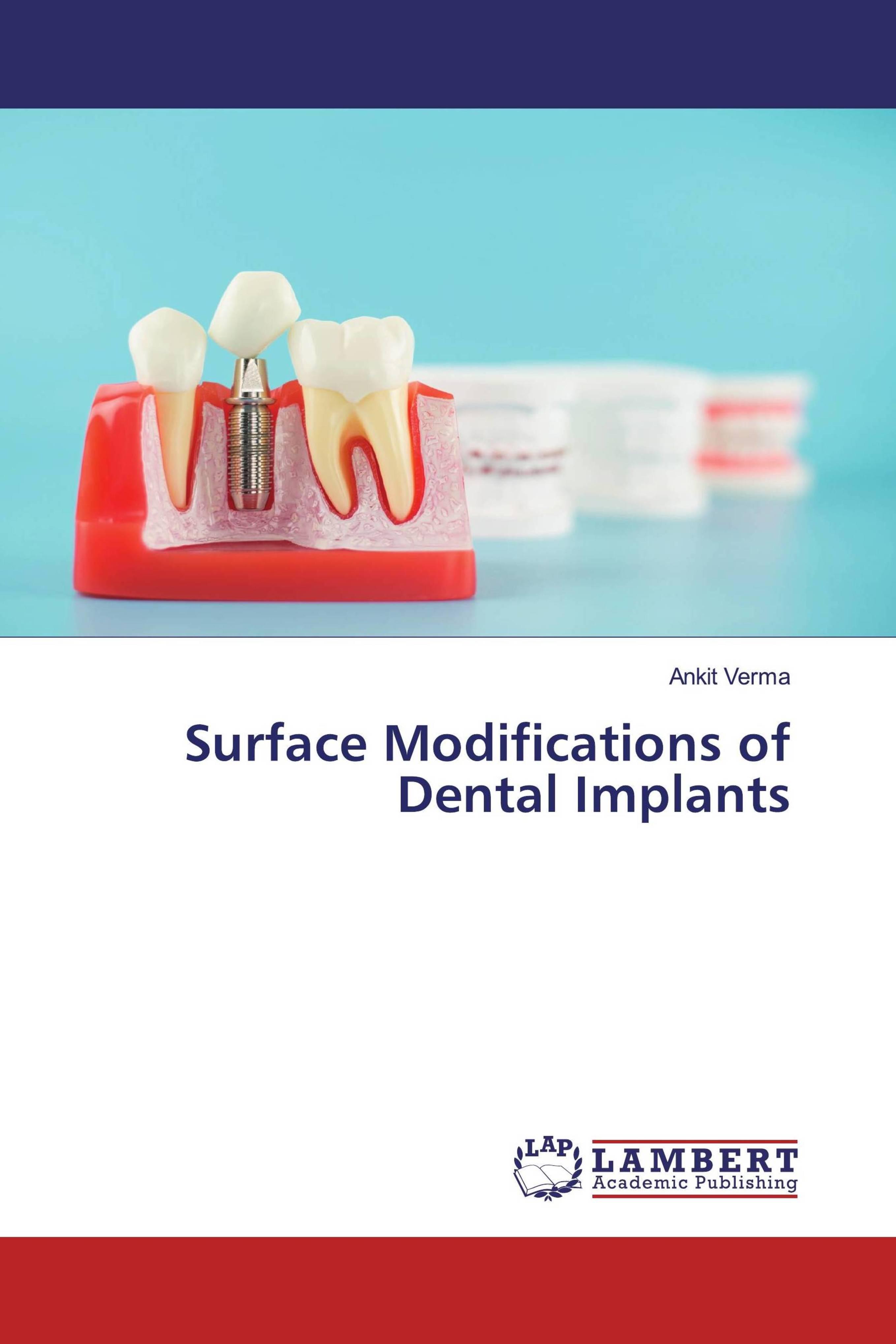预订Surface Modifications of Dental Implants