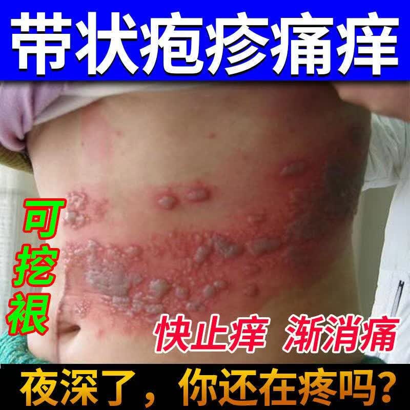溃疡红肿水泡丘1疹瘙痒止痒私处专用喷剂洁阴抑菌肛门肛周瘙痒男女 疱
