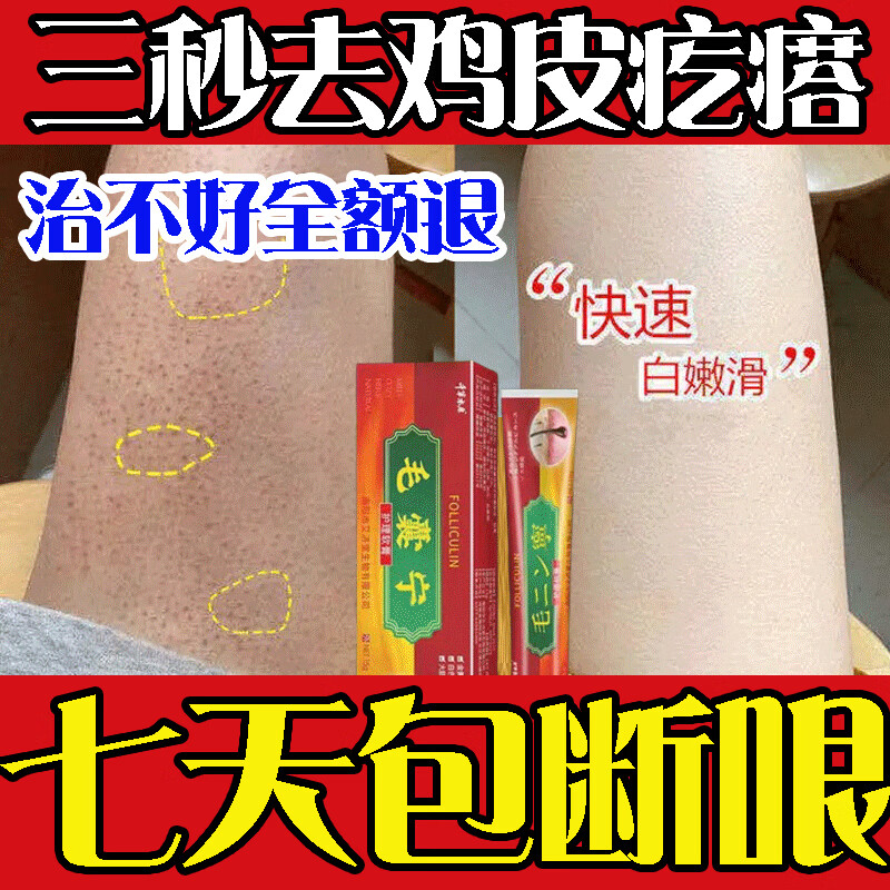 毛囊角化症专用工具药去角质除神器疙瘩大腿去除手臂膏 哏治鸡皮疙瘩