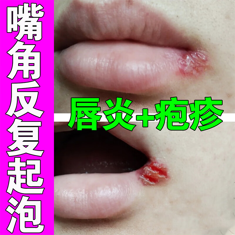 【嘴角长泡】嘴唇干裂脱皮发炎红肿上火起泡裂口嘴角溃烂起水泡唇炎
