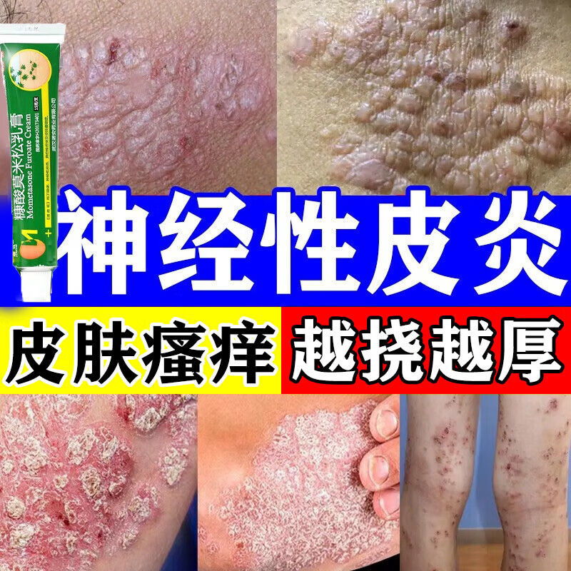 神经性皮炎药 治皮炎湿疹真菌过敏性皮炎皮肤瘙痒止痒特效专用药皮肤