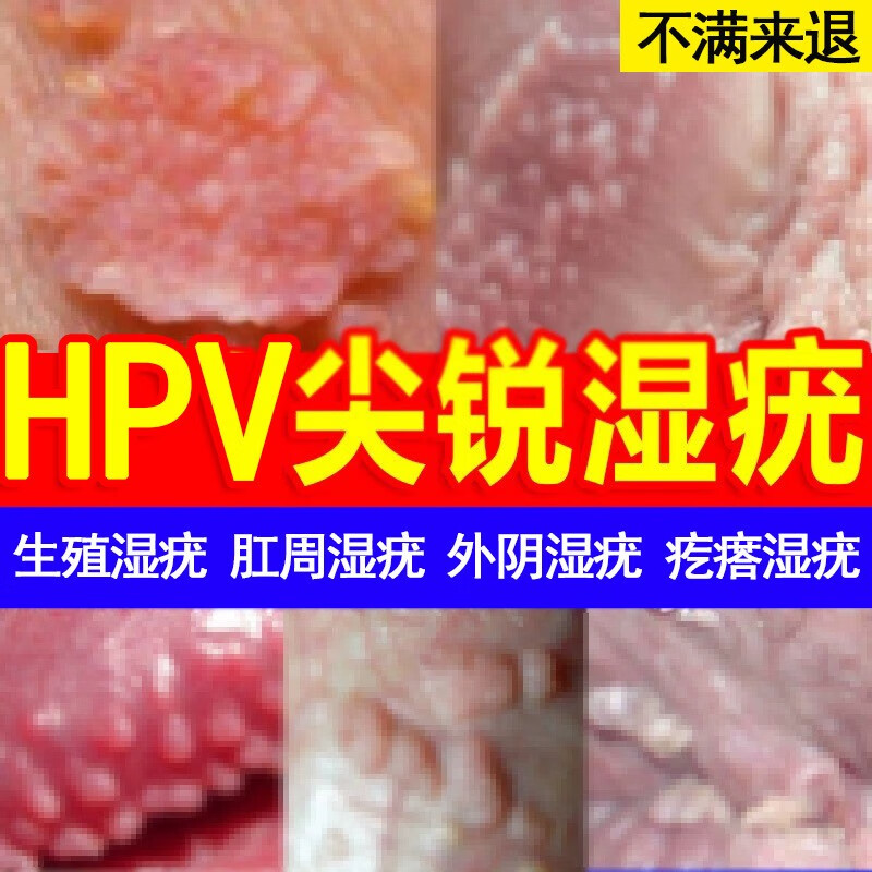 女性hpv病毒早期症状图片