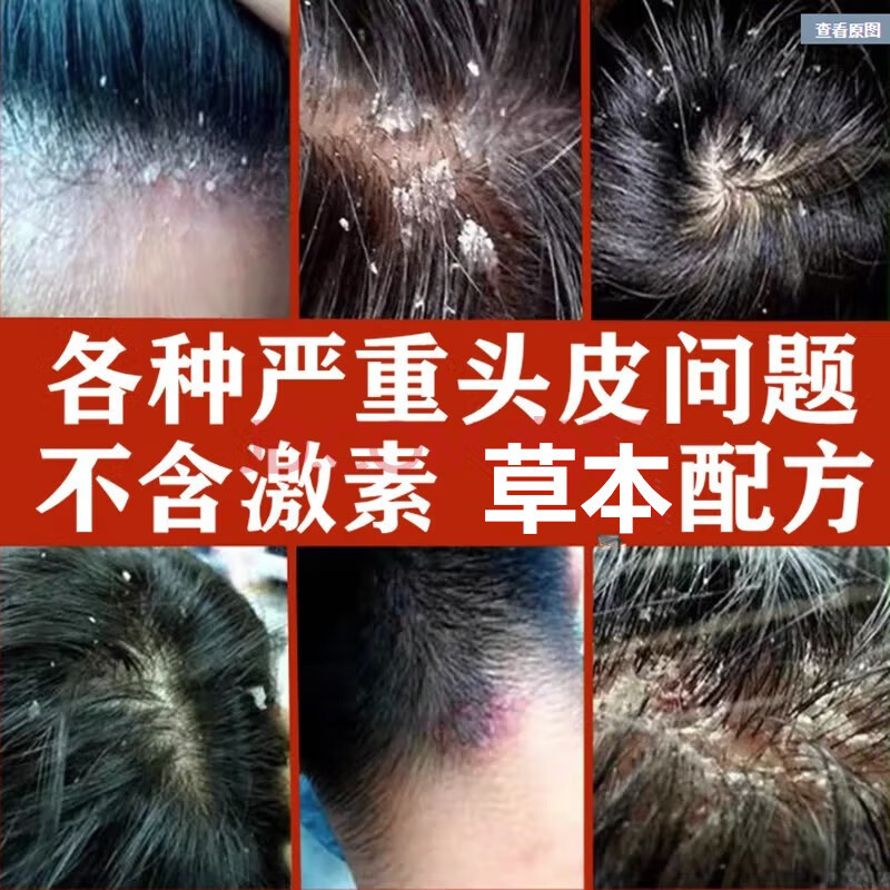 【药房直售】头皮癣银屑洗发水毛发囊炎脂溢性大块头屑瘙痒有疙瘩发