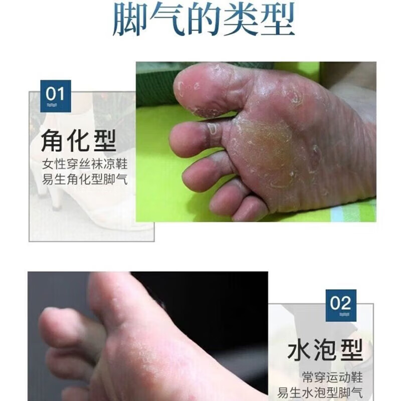 [韩都]克霉唑乳膏 脚气药止痒脱皮烂脚丫真菌感染根烂脚丫药脚趾缝烂痒专用的特新效期药治疗溃烂皮肤用药 1%*10g 1盒装 【医用脚气药】