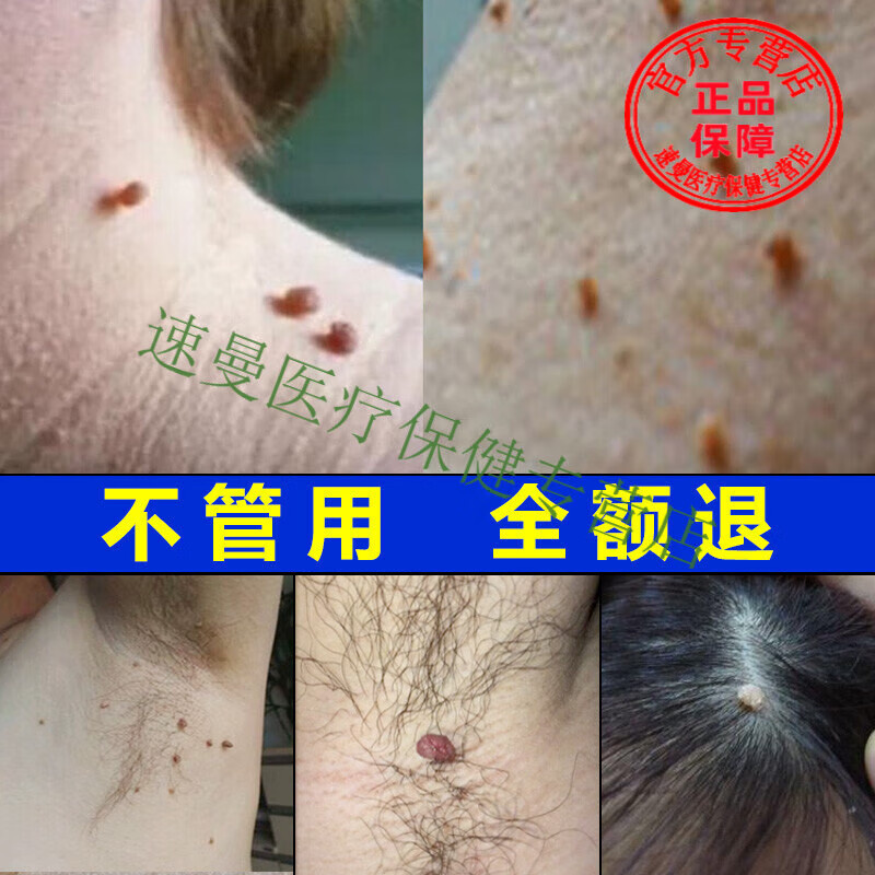 京健康子脖子上长的小肉粒疙瘩痦子腋下皮赘祛除瘊子肉痣 除瘊子 除