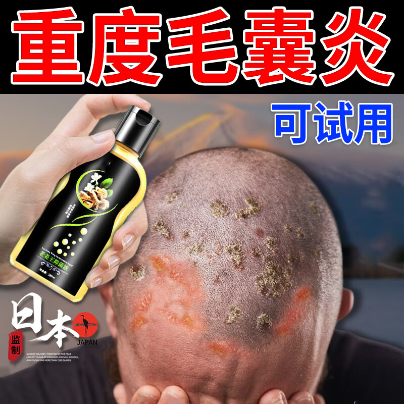 背部中药头皮洗发水头痒头上长疙瘩脓包去屑止头痒止螨虫治疗脂溢皮肤