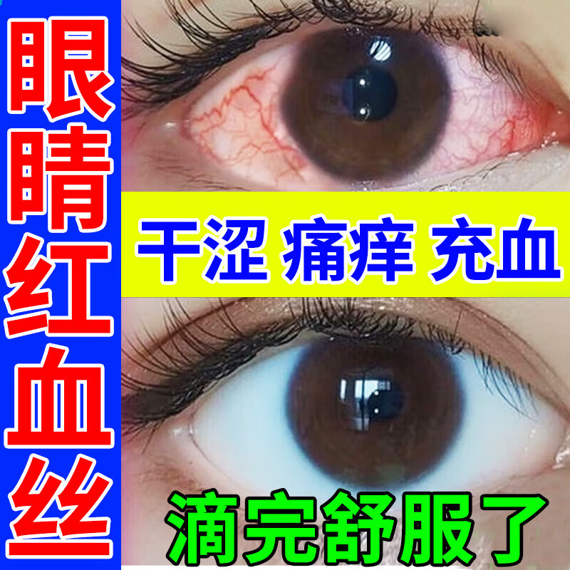 眼睛红血丝眼药水结膜充血眼底出血去i红血丝肿眼干眼涩眼痒用眼过度