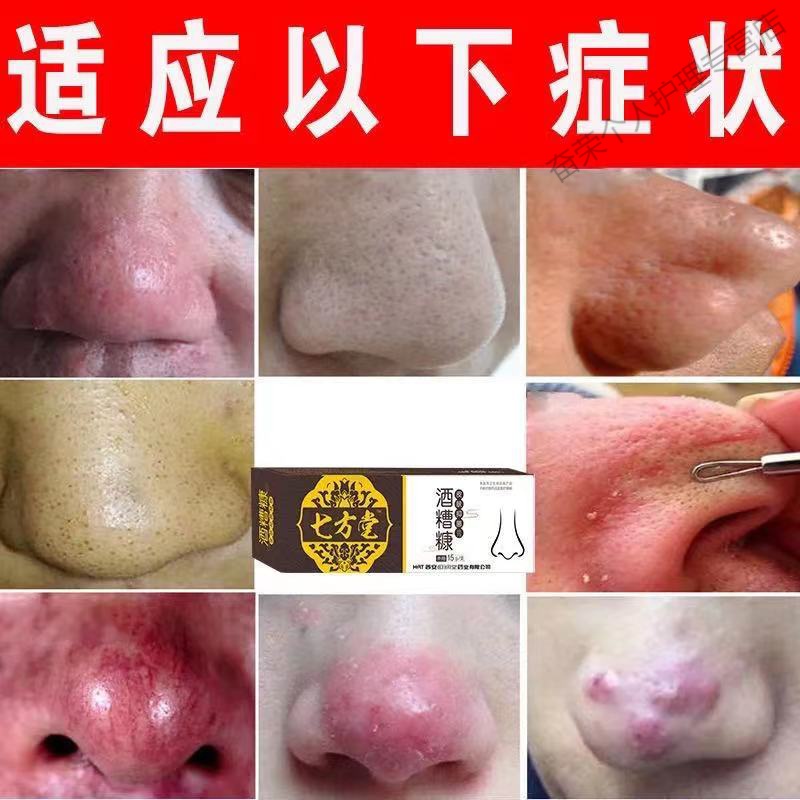 酒糟鼻修复红鼻子软膏草莓鼻螨清酒渣鼻螨虫红鼻子红鼻头暗疮红血丝