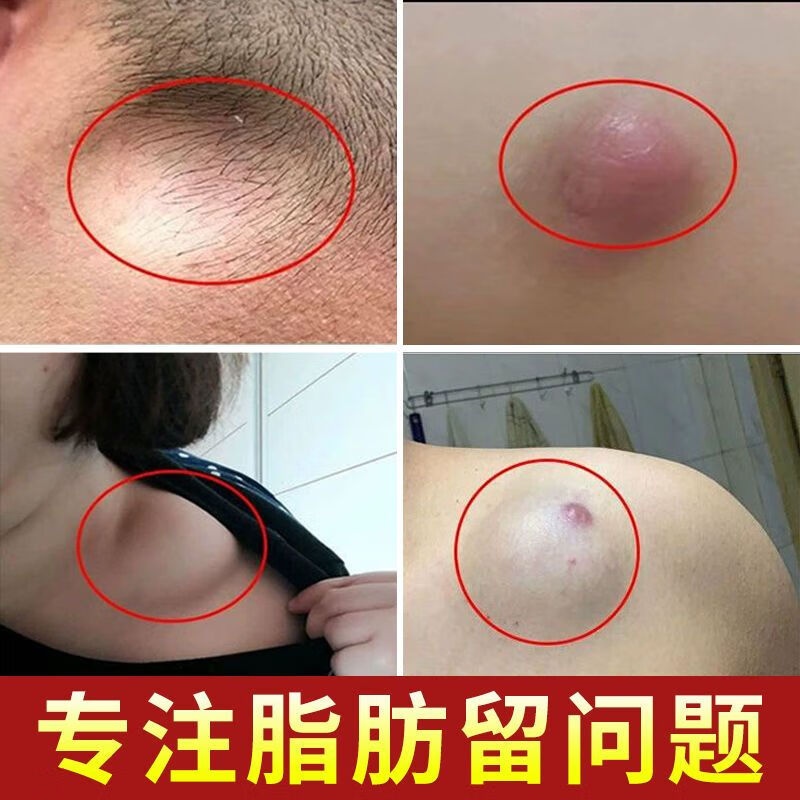 脂肪遛适用凝胶单发性多发性脂肪留皮下脂肪留纤维留硬块肿块凸起 单