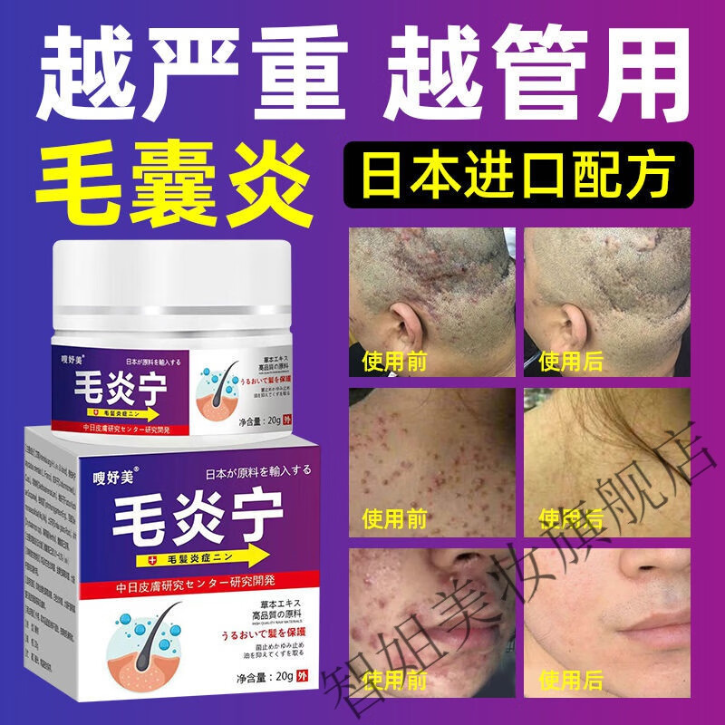 毛囊l炎膏进口头部脸部背胸部痘痘脓l包痤l疮头皮l癣脂溢性皮l炎 1瓶