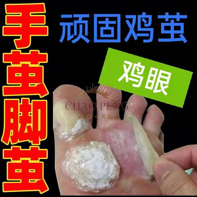 【无痛去鸡i眼】鸡i眼膏贴去老茧脚茧厚茧死皮脚底脚趾脚垫鸡i眼神i器