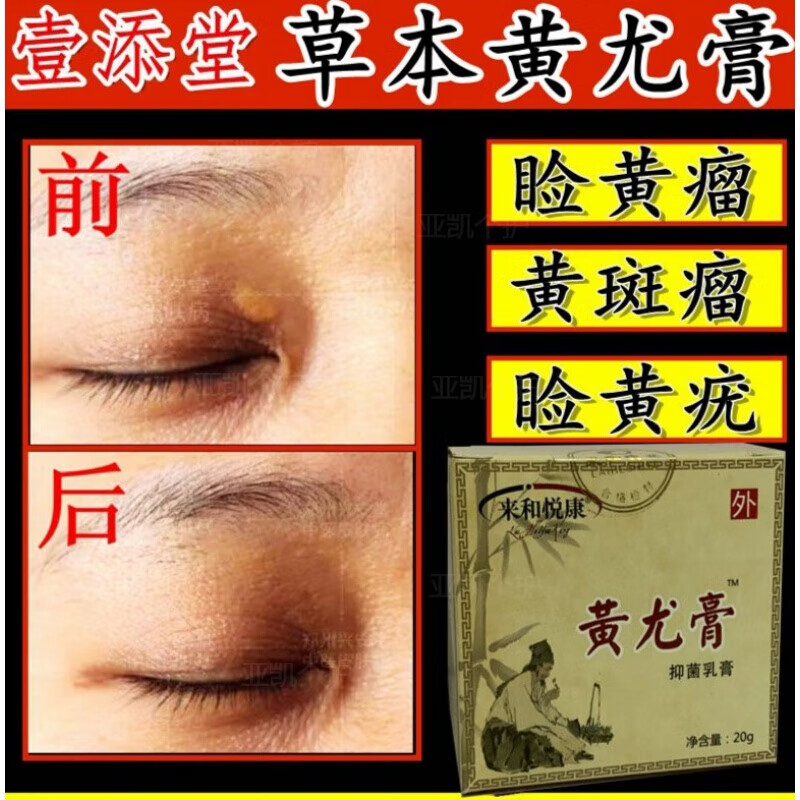 睑黄瘤元康膏睑黄疣膏眼部祛色瘤脸黄斑黄睑瘤元康脸部睑黄瘤膏脂肪粒