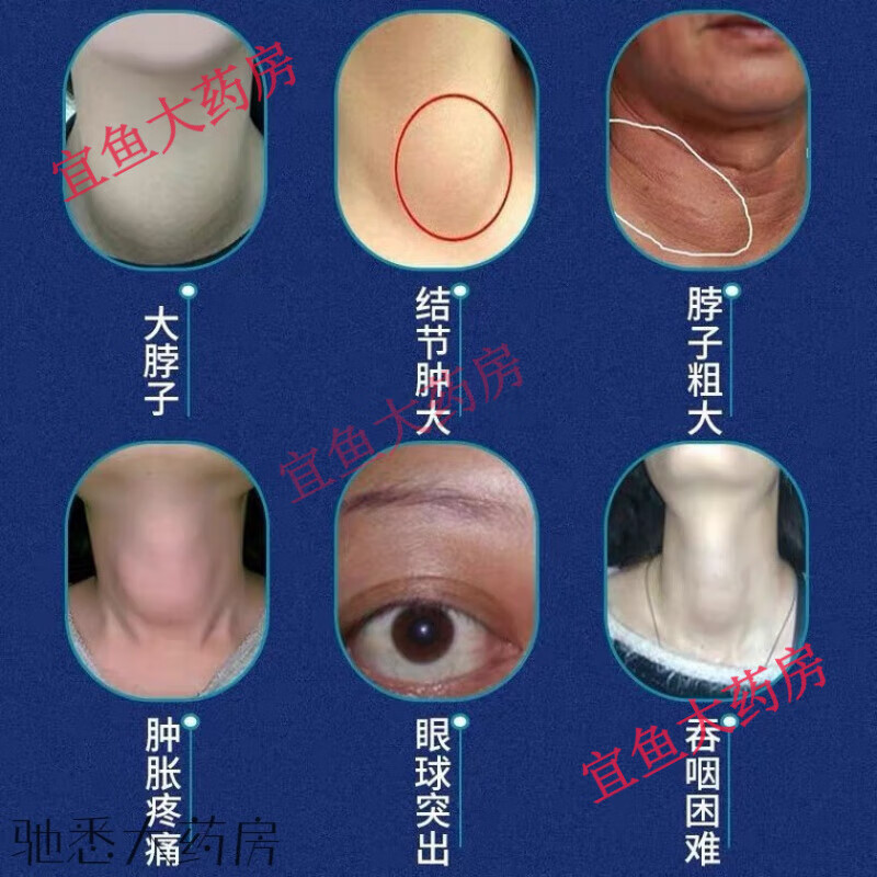 甲状腺结节药仁和甲状腺结节冷敷凝胶颈部脖子甲状腺结节药甲状腺结节冷敷凝胶 3盒周期装