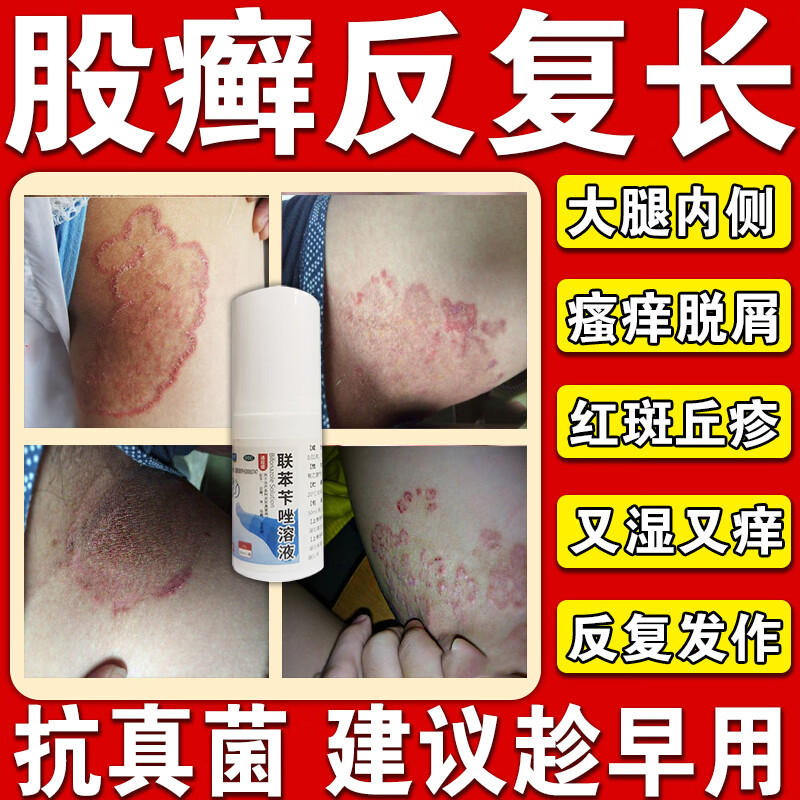 股癣专用药大腿内侧红疹潮湿有异味阴囊私处瘙痒手足癣铜钱癣真菌感染