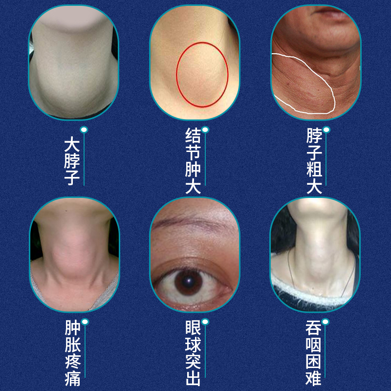 贴李时珍甲状腺消结节散结冷敷贴外用专用贴膏李时珍甲状腺肿大叶子草