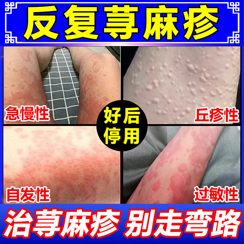荨麻疹过敏止痒专用药 神经性皮炎湿疹皮肤瘙痒风团红斑丘疹划痕长