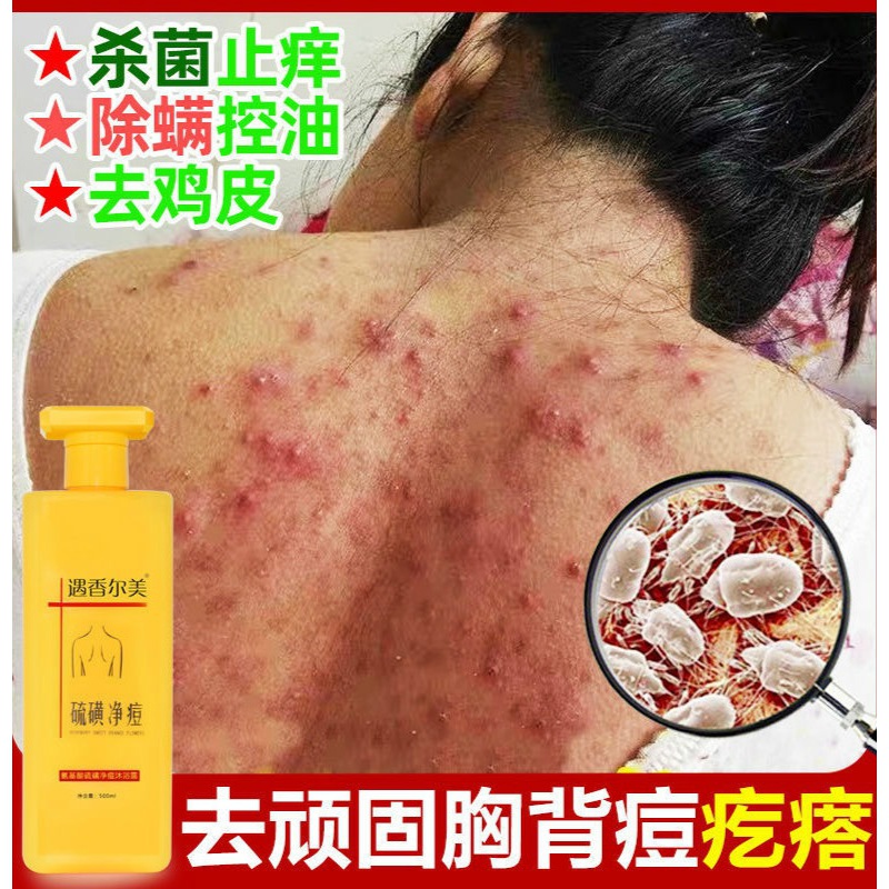 去皮肤鸡皮疙瘩的产品(去皮肤鸡皮疙瘩的产品有哪些)