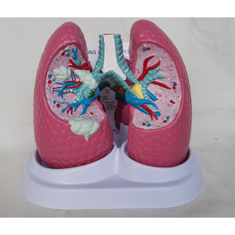 人体肺部病理解剖展示模型内脏结构演示医用教学医患讲解 肺结核与