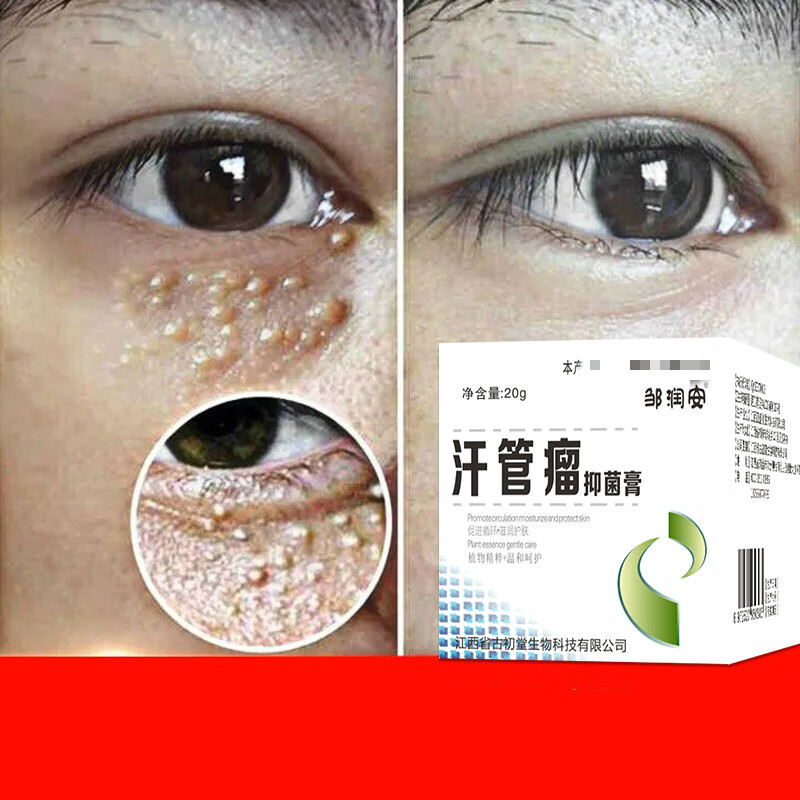 眼部眼霜油脂粒治疗眼周汗管粒 20g