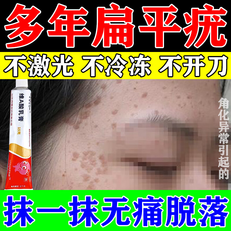 维a酸乳膏扁平疣专用药去疣瘊灵去除脖子上长的小肉粒疙瘩 治疗扁平疣