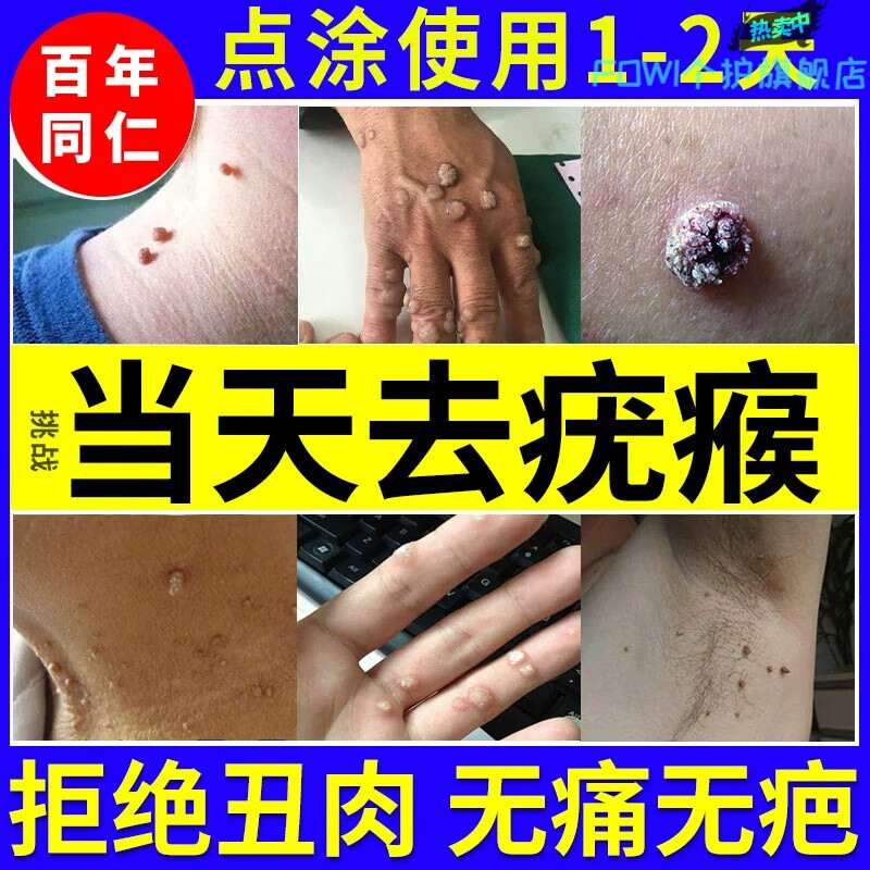 【克疣脖子肉粒去除膏】单盒体验
