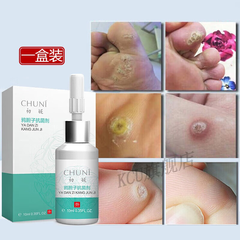 nhfouyou鸦胆子乳膏初一妮鸦胆子成膜剂手脚去老茧肉i刺跖i疣瘊i子赘