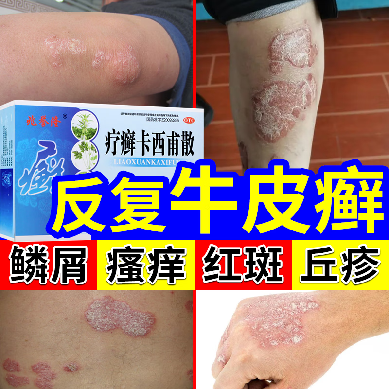 5盒 疗程装【牛皮癣 轻度瘙痒 早吃早治】