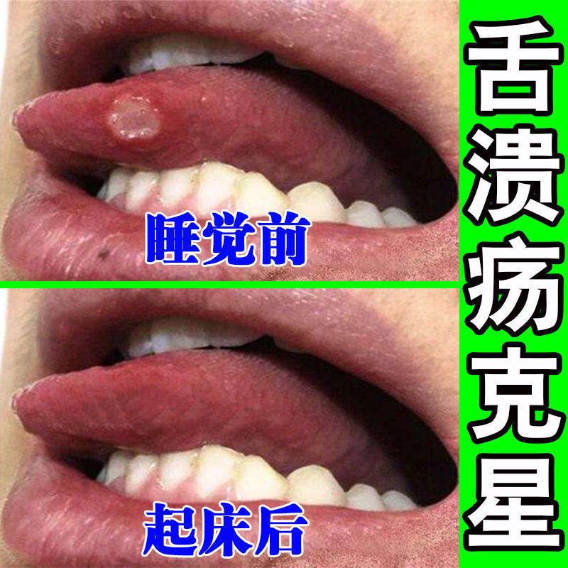 【舌裂不见】舌头开裂舌苔实发白舌炎有舌痕南七珍牙膏 5盒【钜惠装】