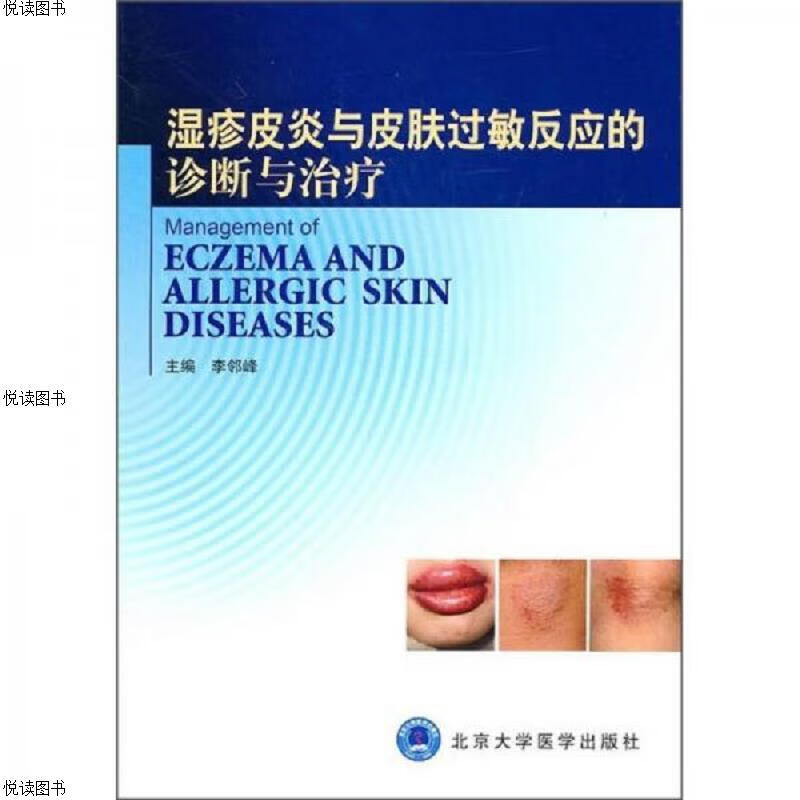 湿疹皮炎与皮肤过敏反应的诊断与*
