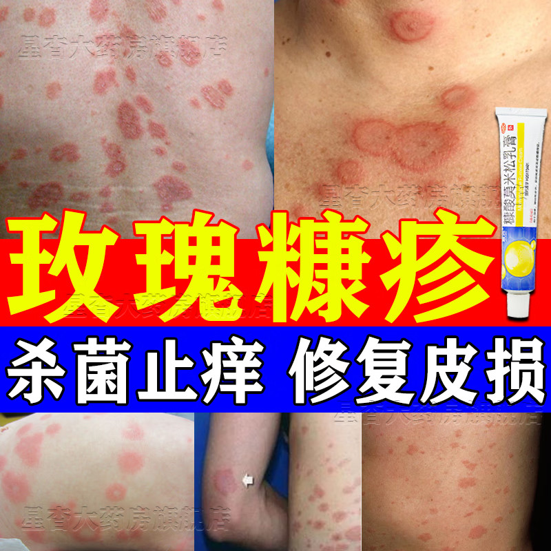 丘疹型荨麻疹红斑湿疹鳞屑全身痒皮肤瘙痒玫瑰糠疹药膏糠酸莫米松乳膏