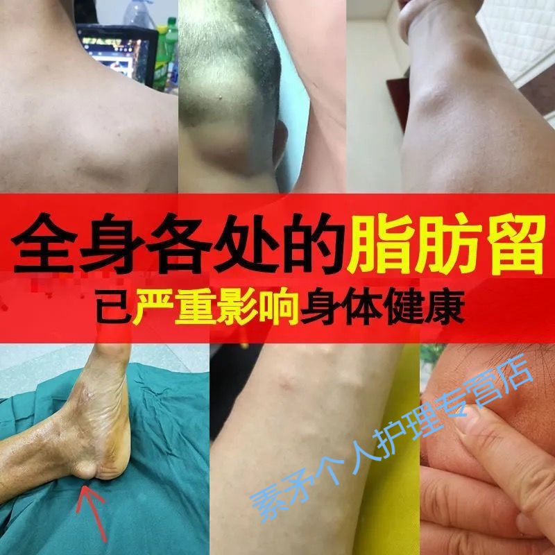 脂肪瘤专用脂肪粒硬块消36种皮下多发性脂肪瘤贴硬块肿块凸起膏箹贴